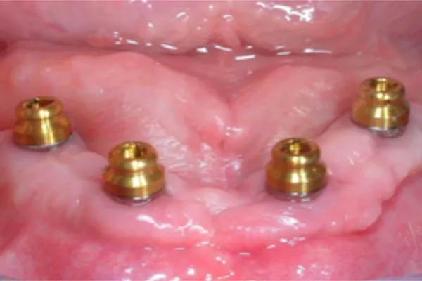 Illustration of implant attachments for denture support