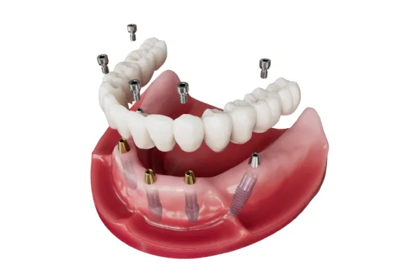Illustration of a fixed full-arch bridge secured to implants